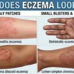 What Does Eczema Look Like